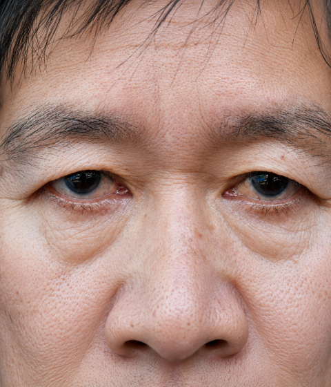 Symptoms of Hooded Eyes