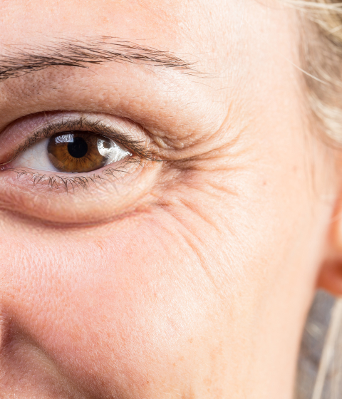 Symptoms of Crow's Feet