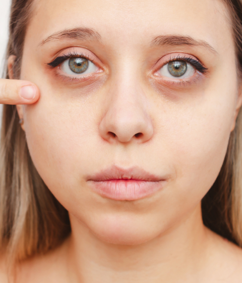 Symptoms of Dark Circles