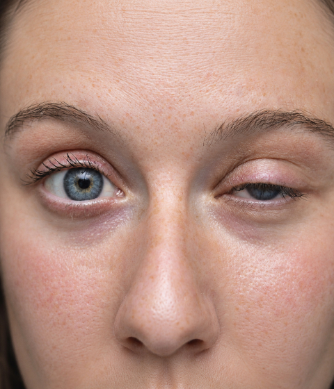 Symptoms of a Droopy Eyelid