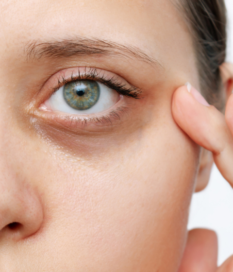 Dark circles treatment — Dr Tanov