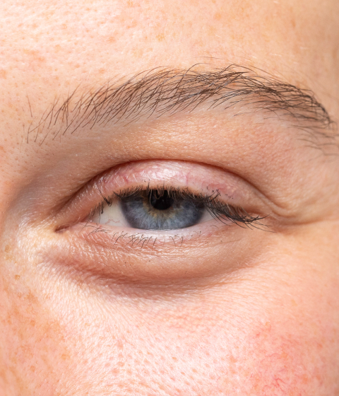 Droopy eyelid (ptosis) treatment — Dr Tanov