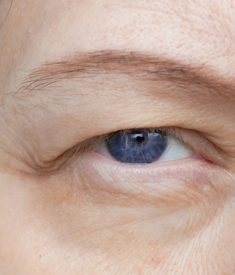 Hooded eyes treatment — Dr Tanov