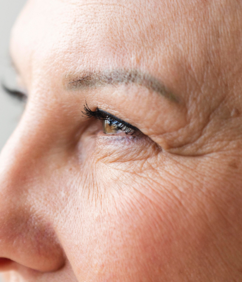 Causes of Crow's Feet