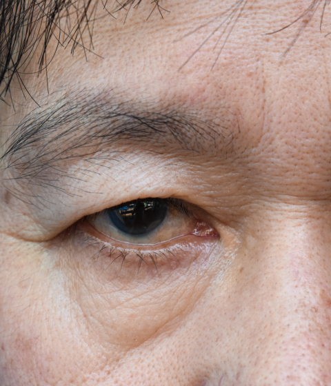 Causes of Hooded Eyes