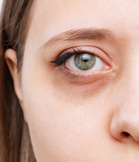 Causes of Dark Circles