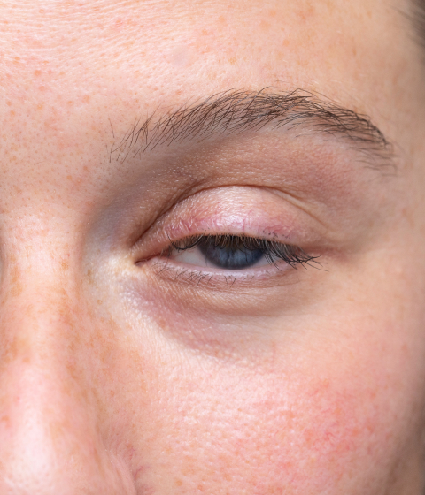 Causes of a Droopy Eyelid